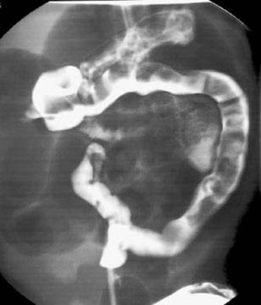 Hirschsprung Disease