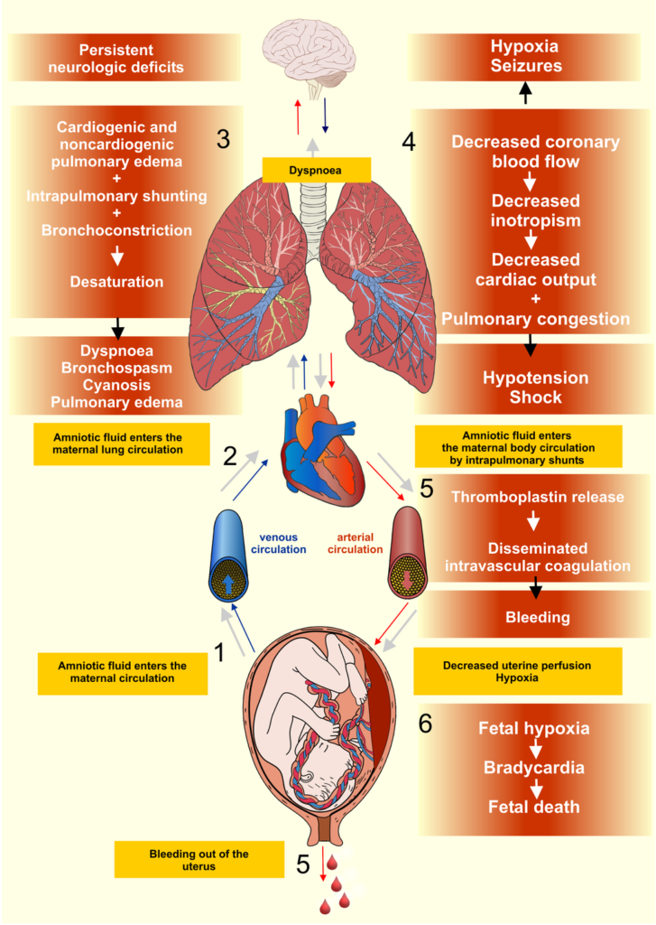 Amniotic Fluid Embolism