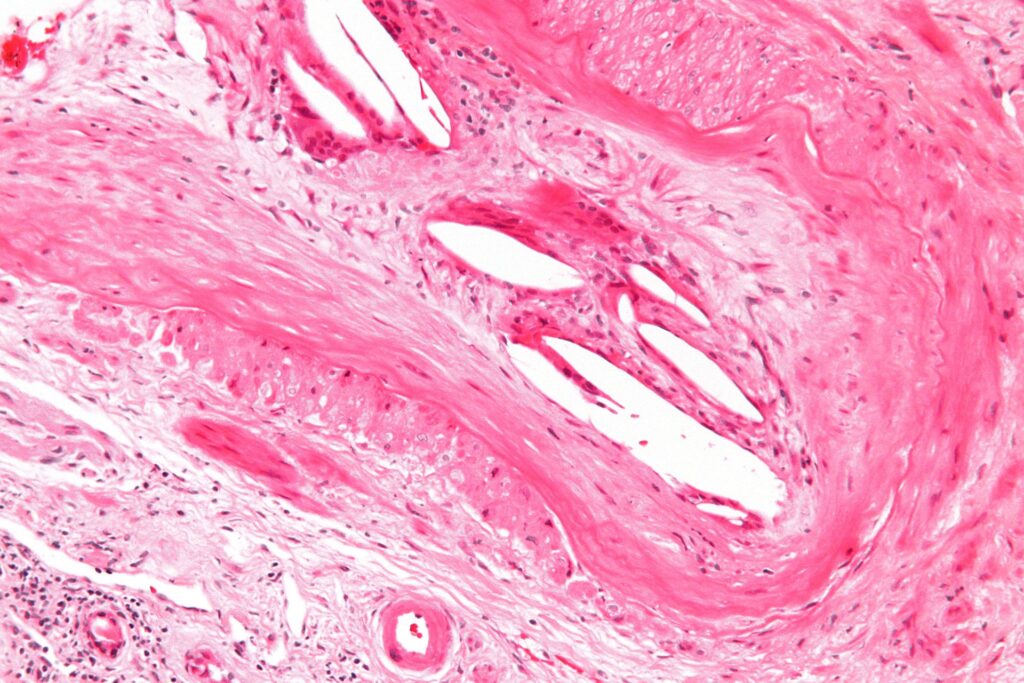 Atherosclerotic Embolus