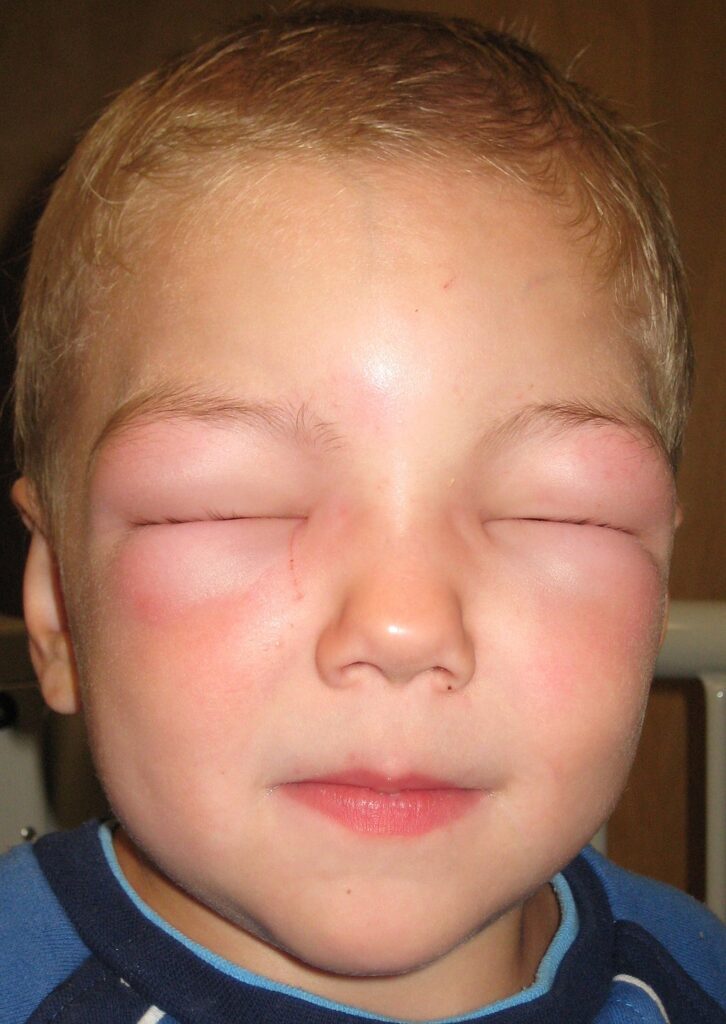 Hereditary Angioedema