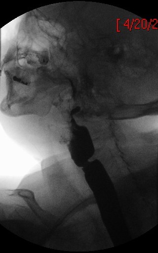 Plummer-Vinson syndrome