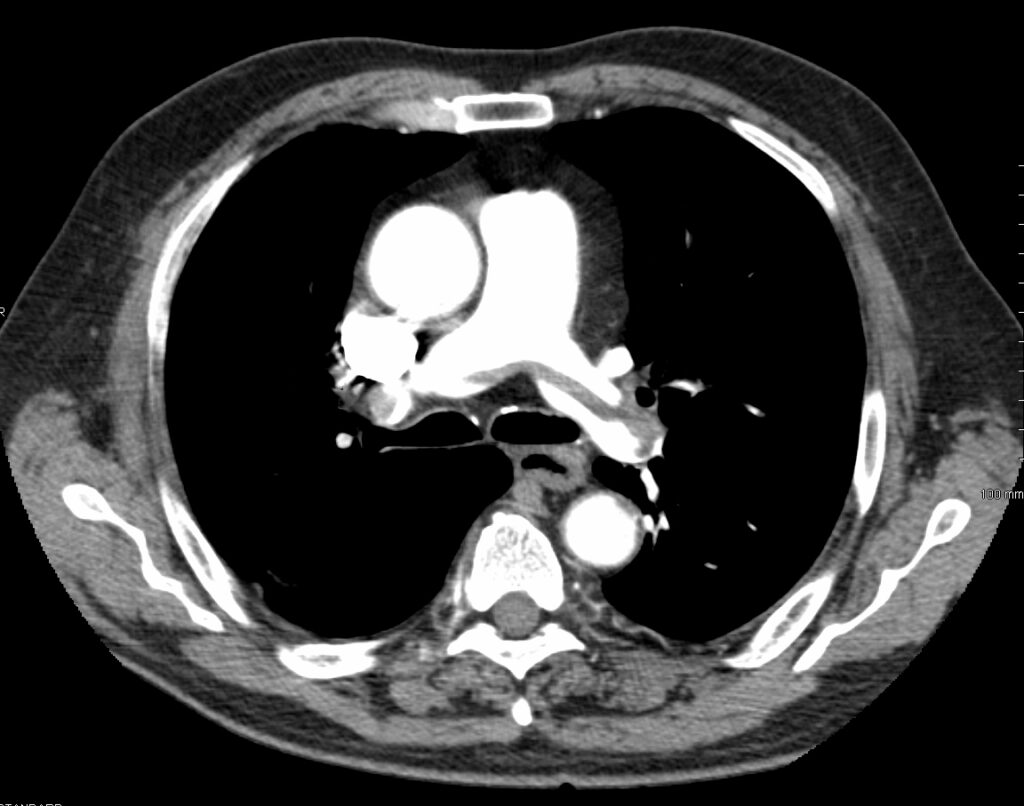 Pulmonary Thromboembolism