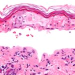 Steven-Johnson-Syndrome