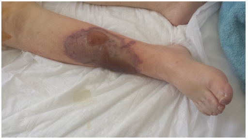 Warfarin Skin Necrosis